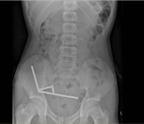 New Zealand Teen Loses Part of His Bowel After Swallowing Nearly 200 Magnets
