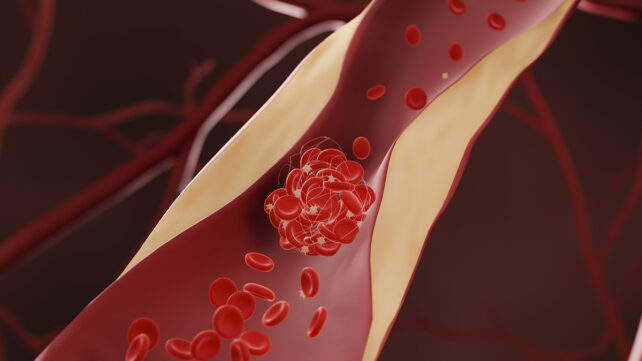 Blocked arteries graphic