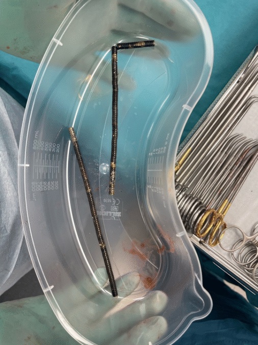 New Zealand Teen Loses Part of His Bowel After Swallowing Nearly 200 Magnets