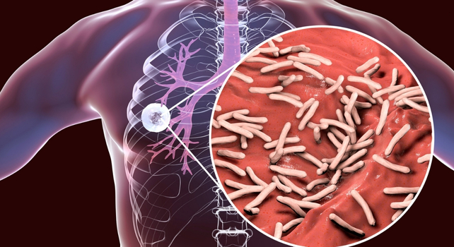illustration of tuberculosis in the lungs