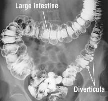 Diverticulosis