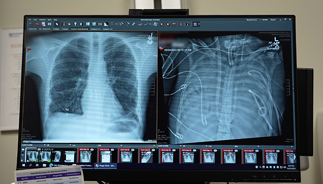 Lung scanning
