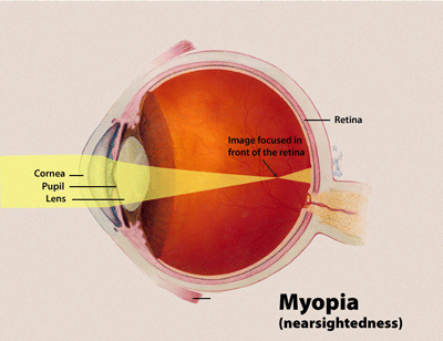 Myopia diagram