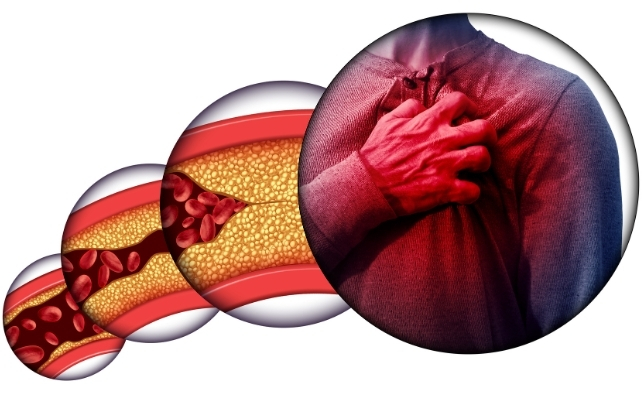 diagram of arteries being blocked