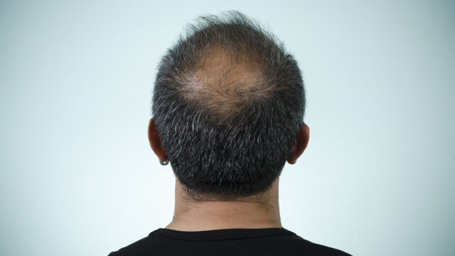 A balding man from behind
