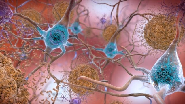 illustration of amyloid beta plaques in Alzheimer's disease