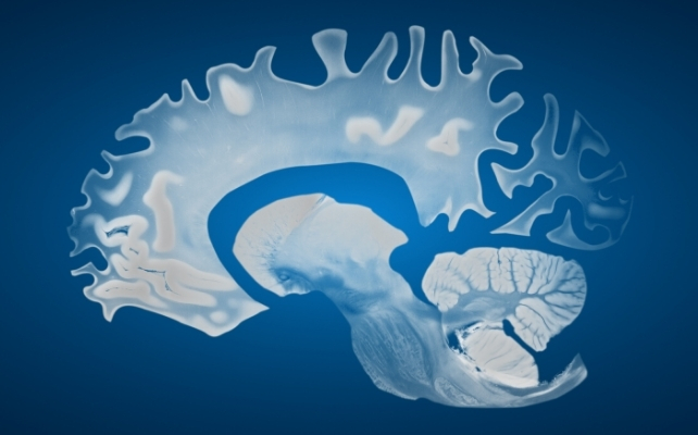 blue brain with dementia