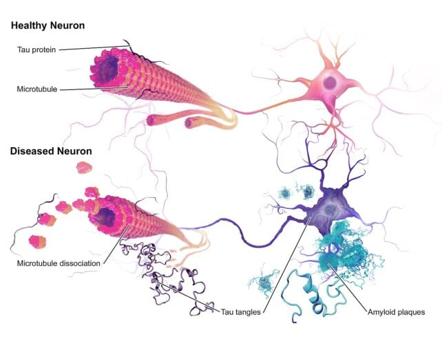 A Competition Between Essential Brain Proteins May Drive Alzheimer's Disease, New Research Suggests