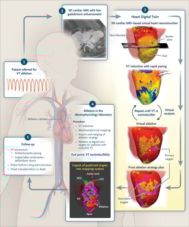 Digital Twin of a Patient's Heart Helped Doctors Treat a Deadly Rhythm
