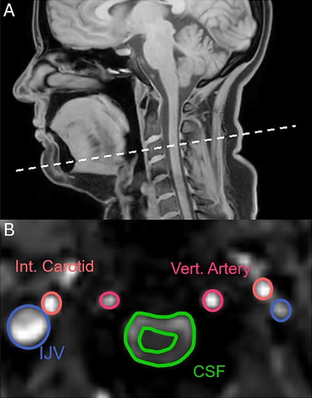 Brain fluid flow