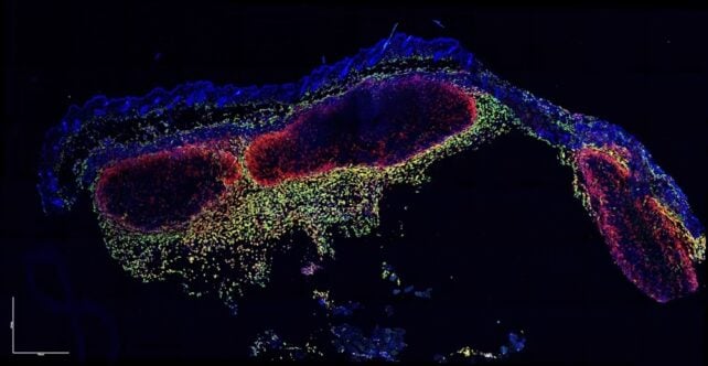 Watch: Immune Cells Caught on Video Eating Live Skin Cancer Cells