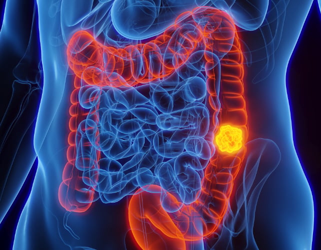 bowel cancer diagram