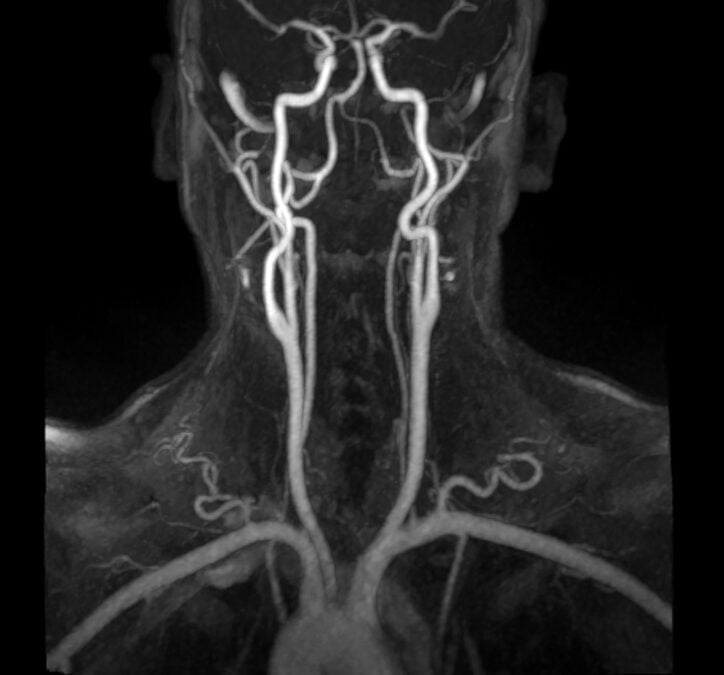Scientists Find "Ominous" Signs of Artery Damage in Surprisingly Young Adults