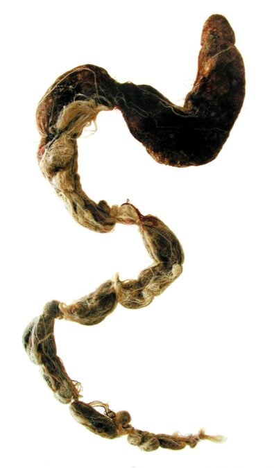 Extremely Rare Syndrome Can Cause a Hairball So Long It Requires Surgery
