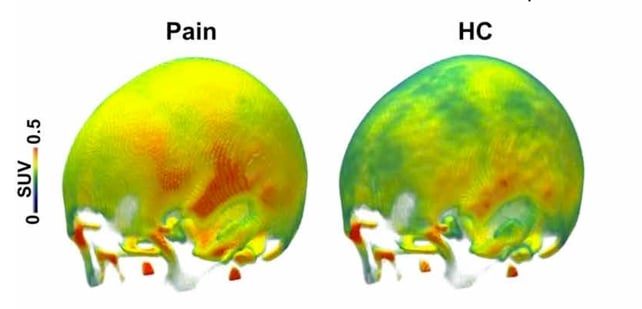 A Hidden Source of Chronic Pain May Be Lurking Inside Your Skull, Study Finds