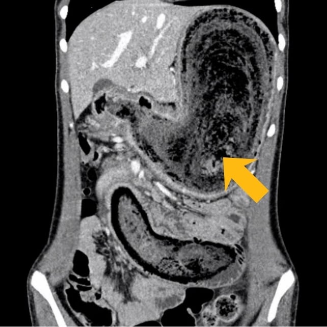 Extremely Rare 'Rapunzel Syndrome' Can Cause a Hairball So Long It Requires Surgery