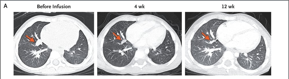 A 3-Year-Old's Metastatic Cancer Disappeared After Two Doses of Experimental Therapy