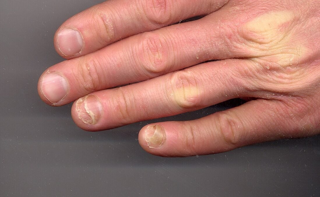 Some People Taking Ozempic-Like Drugs Are Reporting Their Fingernails Detaching