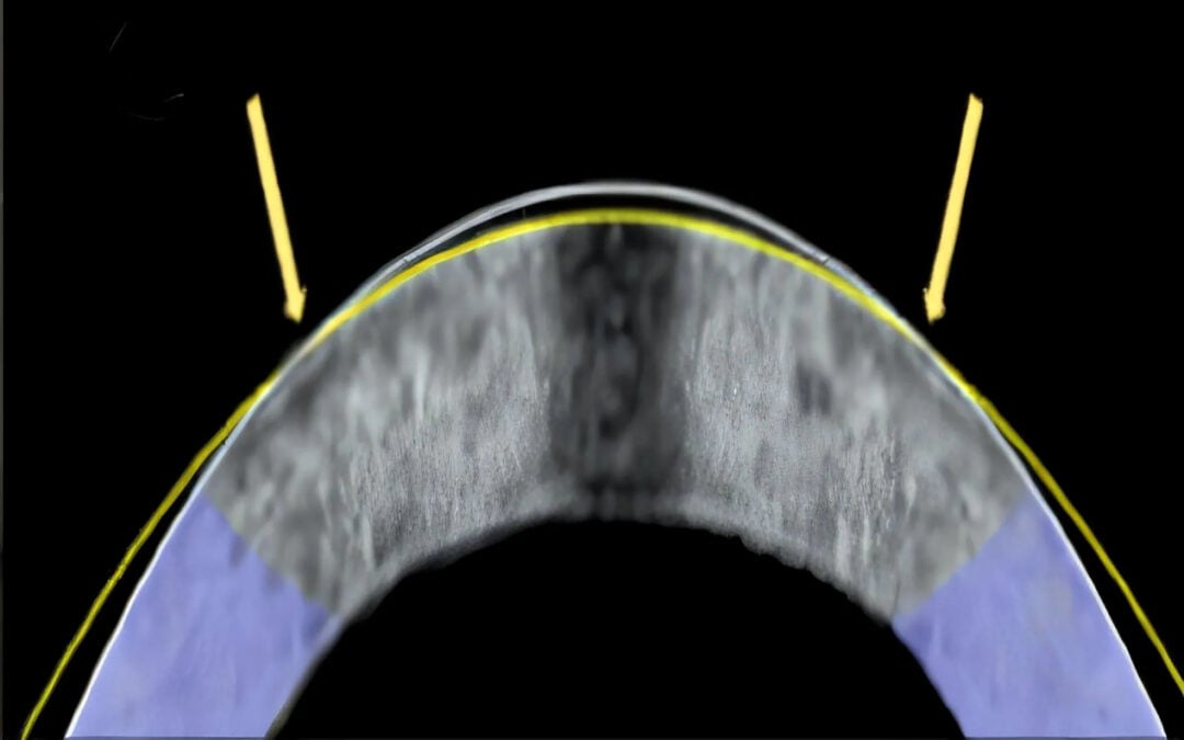 Cross section of a rabbit cornea with a white line marking its original curvature and a yellow line marking its flatter shape after electromechanical reshaping.